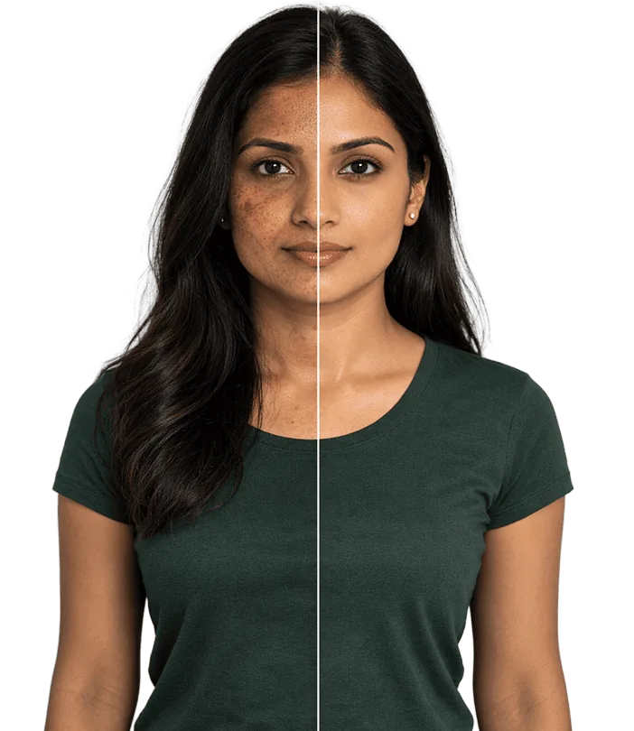 Melasma And Dark Spots Treatment In Chennai Banner1