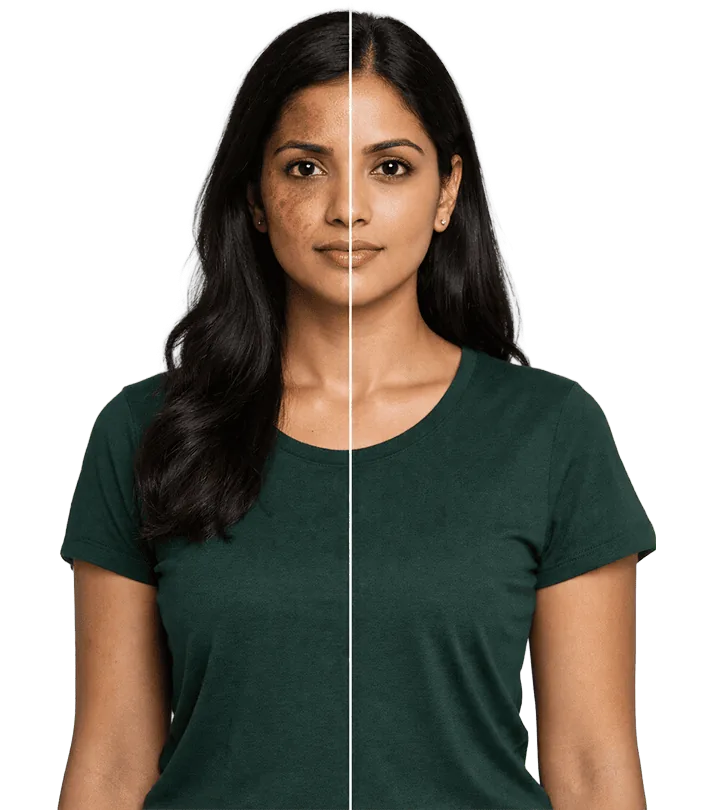 Melasma And Dark Spots Treatment In Chennai Banner