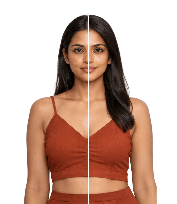 Rf Micro Needling Treatment In Chennai Banner