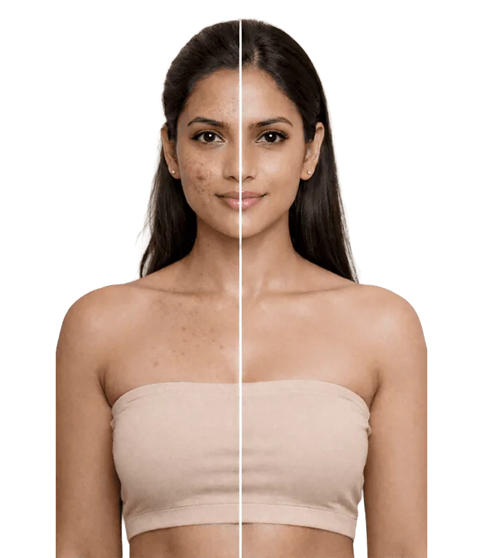 Skin Resurfacing Treatment In Chennai Banner1