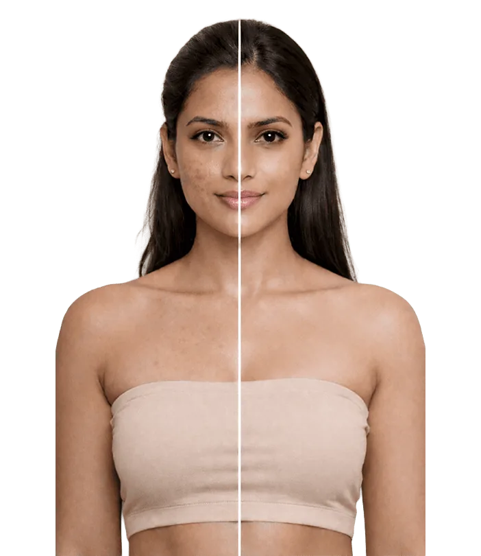 Skin Resurfacing Treatment In Chennai Banner