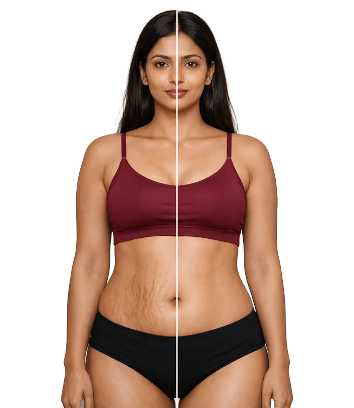 Stretch Mark Treatment In Chennai Banner1