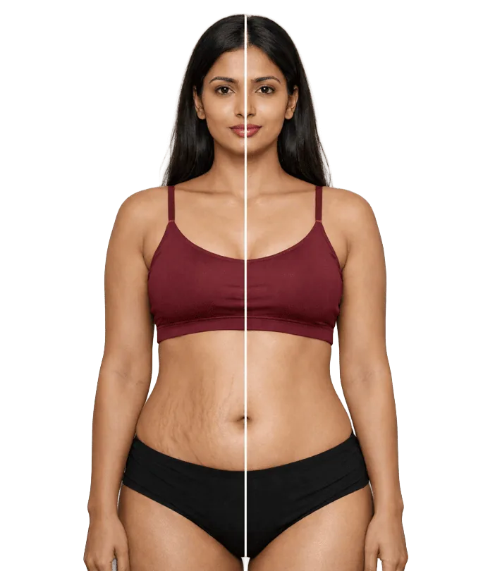 Stretch Mark Treatment In Chennai Banner
