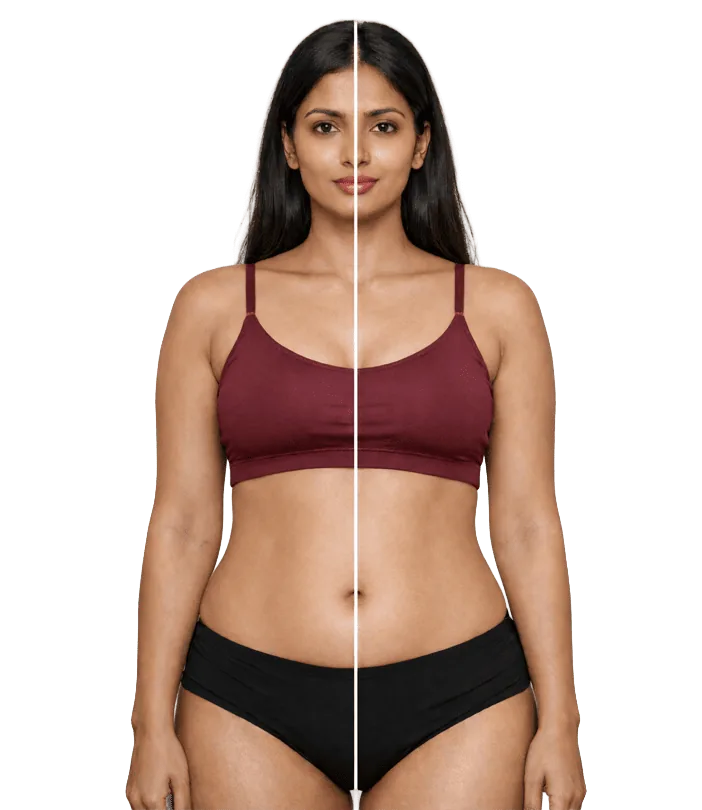 Stretch Mark Treatment In Chennai Banner3