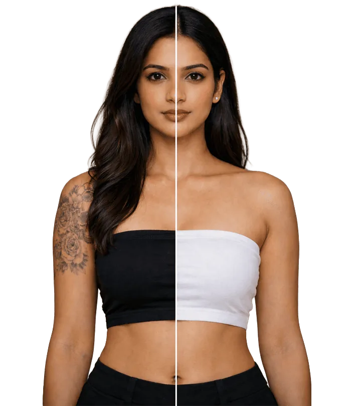 Tattooremoval Treatment In Chennai Banner