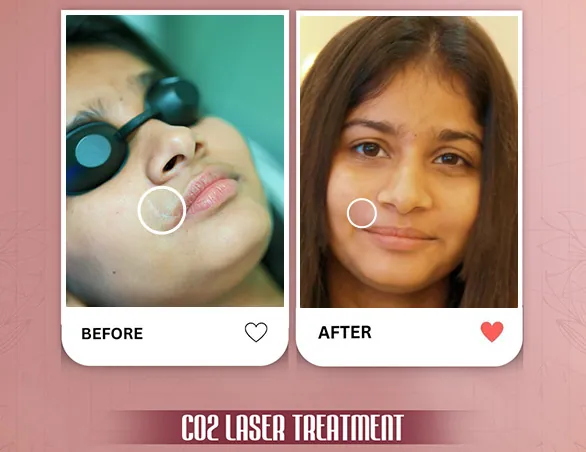 Before and after CO2 laser treatment at VK Allure Dermaclinic