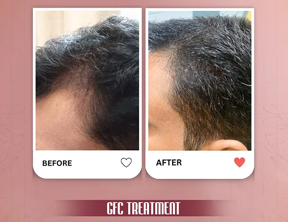 Before and after GFC hair treatment at VK Allure Dermaclinic