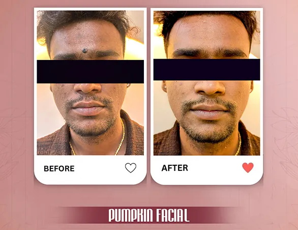 Before and after pumpkin facial at VK Allure Dermaclinic