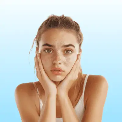 Acne Scar Removal Treatment