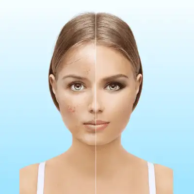 Pigmentation Treatment