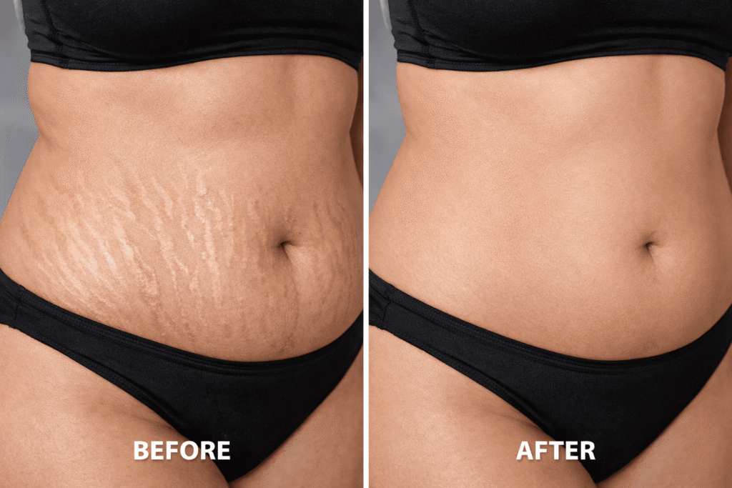 Stretch Mark Reduction