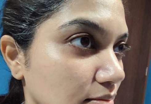After Hydrafacial booster — brighter even-toned skin VK Allure