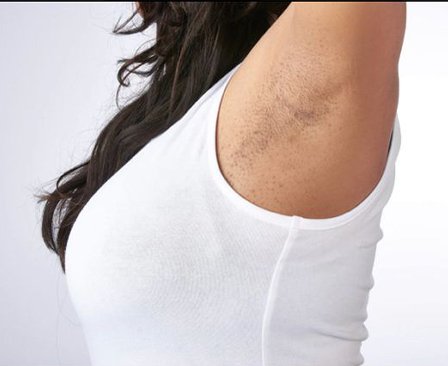 Before laser hair removal underarms