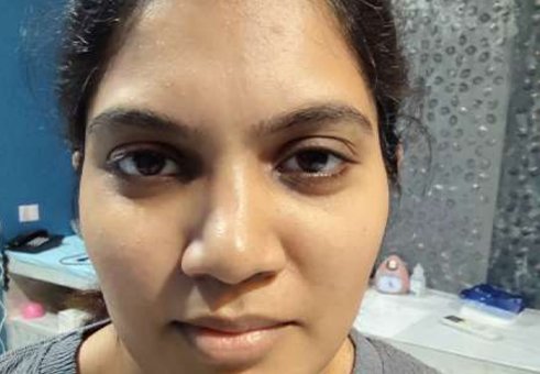 Before Hydrafacial — acne marks and uneven skin tone Chennai