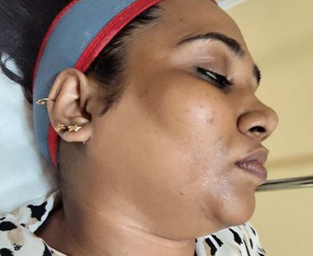 After laser hair removal face