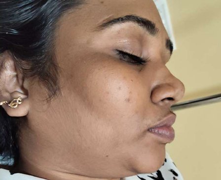 Before laser hair removal face