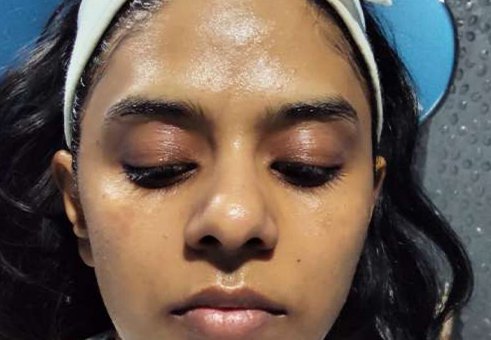 After Hydrafacial — glowing hydrated skin Chennai VK Allure