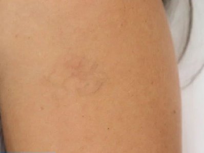 Tatoo After